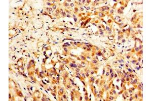 IHC image of ABIN7171484 diluted at 1:400 and staining in paraffin-embedded human liver cancer performed on a Leica BondTM system. (TLN1 anticorps  (AA 92-399))
