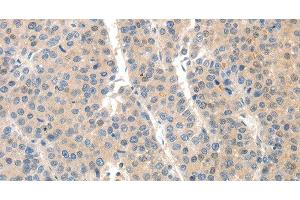 Immunohistochemistry of paraffin-embedded Human liver cancer tissue using SLC20A1 Polyclonal Antibody at dilution 1:40