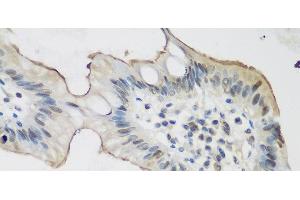 Immunohistochemistry of paraffin-embedded Human stomach cancer using ALOX15 Polyclonal Antibody at dilution of 1:200 (40x lens).