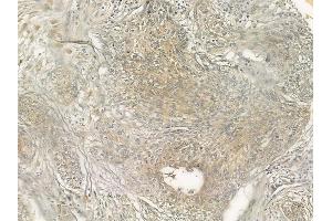 ABIN6266254 and ABIN6277415 at 1/100 staining human cervical carcinoma by IHC-P. (NFASC anticorps  (C-Term))