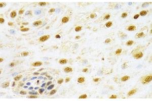 Immunohistochemistry of paraffin-embedded Human esophageal cancer using RUNX1 Polyclonal Antibody at dilution of 1:100 (40x lens). (RUNX1 anticorps)