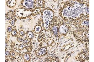CREB Mouse monoclonal antibody at 1/100 staining human ovarian cancer by IHC-P.
