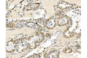 ABIN7097036 and ABIN7101103 at 1/100 staining human ovarian cancer by IHC-P.