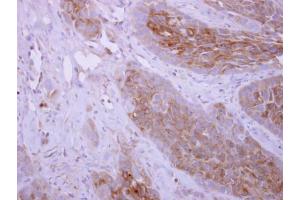 IHC-P Image DPYD antibody [N1N2], N-term detects DPYD protein at cytoplasm on H358 xenograft by immunohistochemical analysis. (DPYD anticorps)
