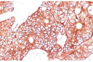 Immunohistochemistry of paraffin-embedded Human colon carcinoma using FAM98A Polyclonal Antibody at dilution of 1:100 (40x lens).