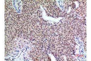 Immunohistochemistry (IHC) analysis of paraffin-embedded Human Mammary Cancer, antibody was diluted at 1:100. (P57 (Ser24) anticorps)