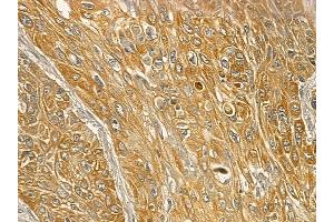 Mitofusin 2 Mouse Monoclonal Antibody at 1/100 staining human esophageal cancer and adjacent non-tumor tissue by IHC-P. (MFN2 anticorps)