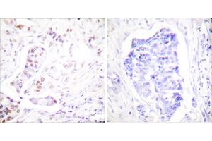 Peptide - +Immunohistochemical analysis of paraffin-embedded human breast carcinoma tissue using Cyclin A1 antibody (#C0166). (Cyclin A1 anticorps)