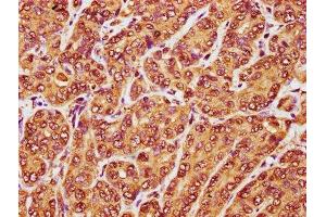 IHC image of ABIN7167090 diluted at 1:100 and staining in paraffin-embedded human liver cancer performed on a Leica BondTM system.