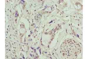 Immunohistochemistry of paraffin-embedded human pancreatic cancer using ABIN7173237 at dilution of 1:100 (TMEM53 anticorps  (AA 1-170))