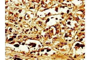 Immunohistochemistry of paraffin-embedded human melanoma using ABIN7146085 at dilution of 1: 100