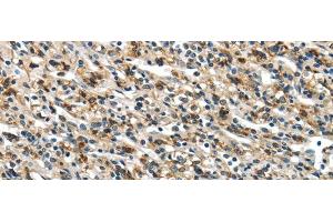 Immunohistochemistry of paraffin-embedded Human prostate cancer using GLP2R Polyclonal Antibody at dilution of 1/30 (GLP2R anticorps)