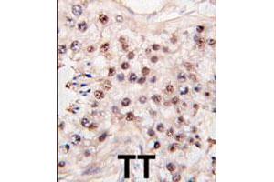 Formalin-fixed and paraffin-embedded human testicle tumor tissue reacted with HDAC11 polyclonal antibody  , which was peroxidase-conjugated to the secondary antibody, followed by DAB staining. (HDAC11 anticorps  (C-Term))
