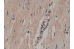 Detection of ATP1b3 in Human Colorectal cancer Tissue using Polyclonal Antibody to Sodium/potassium Transporting ATPase Subunit Beta-3 (ATP1b3)