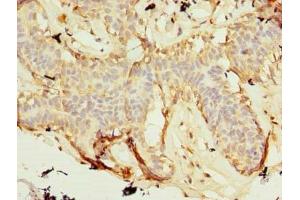 Immunohistochemistry of paraffin-embedded human breast cancer using ABIN7176140 at dilution of 1:100 (ZNF19 anticorps  (AA 1-200))