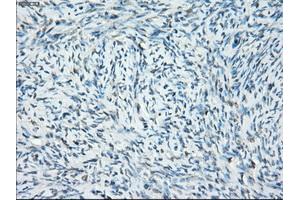 Immunohistochemical staining of paraffin-embedded Adenocarcinoma of breast tissue using anti-SSX2 mouse monoclonal antibody. (SSX2 anticorps)