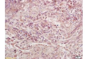 Formalin-fixed and paraffin embedded human colon carcinoma labeled with Anti-GNAO1/G0 Polyclonal Antibody, Unconjugated (ABIN872799) at 1:200 followed by conjugation to the secondary antibody and DAB staining.