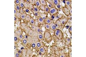Immunohistochemical analysis of AP2-alpha-2 staining in human liver cancer formalin fixed paraffin embedded tissue section.