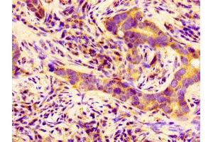 Immunohistochemistry of paraffin-embedded human pancreatic cancer using ABIN7145263 at dilution of 1:100 (BCAM anticorps  (AA 447-547))
