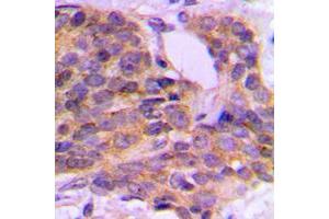 Immunohistochemical analysis of PKC theta (pS676) staining in human breast cancer formalin fixed paraffin embedded tissue section. (PKC theta anticorps  (C-Term, pSer676))