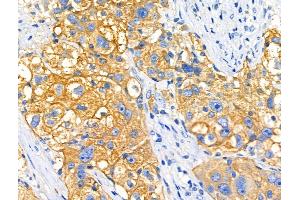 ABIN6256909 and ABIN6274864 at 1/100 staining Human ovarian cancer by IHC-P.