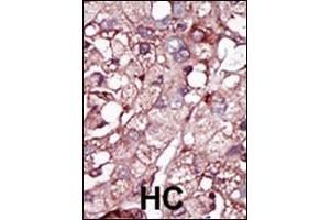 Formalin-fixed and paraffin-embedded human cancer tissue reacted with the primary antibody, which was peroxidase-conjugated to the secondary antibody, followed by DAB staining.