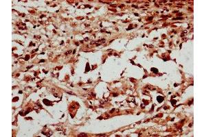 IHC image of ABIN7150959 diluted at 1:600 and staining in paraffin-embedded human melanoma performed on a Leica BondTM system. (NSMCE2 anticorps  (AA 1-247))