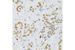 Immunohistochemistry of paraffin-embedded human breast cancer using HMGB1 Antibody. (HMGB1 anticorps  (AA 100-200))