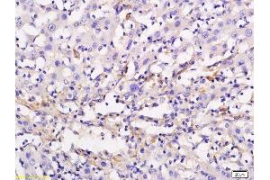 Formalin-fixed and paraffin embedded human liver cancer labeled with Anti ADCY10 Polyclonal Antibody, Unconjugated  followed by conjugation to the secondary antibody and DAB staining