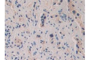 Detection of SEMA3A in Human Prostate cancer Tissue using Polyclonal Antibody to Semaphorin 3A (SEMA3A)