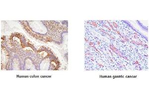Paraffin embedded sections of human colon and gastric canitrocelluloseer tissue were initrocelluloseubated with anti-human EphA2 (1:100) for 2 hours at room temperature.