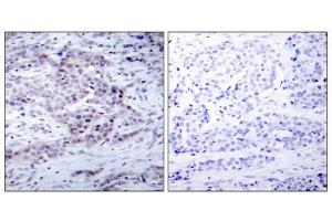 Immunohistochemical analysis of paraffin-embedded human breast carcinoma tissue using NF-κ,B p100(phospho- Ser870) antibody. (NFKB2 anticorps  (pSer870))