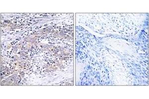 Immunohistochemistry analysis of paraffin-embedded human cervix carcinoma tissue, using CLN6 Antibody.