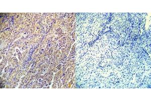 Immunohistochemical analysis of paraffin-embedded human lung carcinoma tissue using AMPKbeta1 (phospho-Ser182) (E012004). (PRKAB1 anticorps  (pSer182))