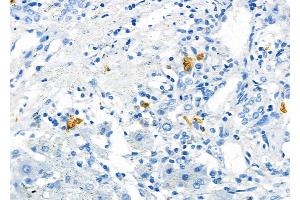 ABIN6266273 and ABIN6277461 at 1/100 staining Human liver cancer and adjacent normal tissues by IHC-P.