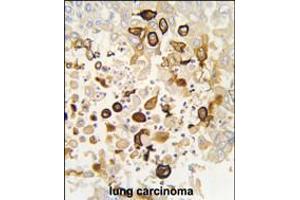Formalin-fixed and paraffin-embedded human lung carcinoma tissue reacted with CYP4X1 antibody (N-term), which was peroxidase-conjugated to the secondary antibody, followed by DAB staining. (CYP4X1 anticorps  (N-Term))