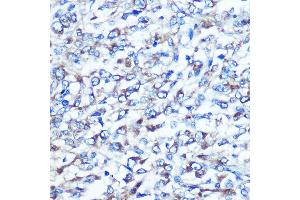 Immunohistochemistry of paraffin-embedded human liver cancer using OPTN Rabbit pAb (ABIN3015612, ABIN3015613, ABIN3015614 and ABIN6218972) at dilution of 1:100 (40x lens).