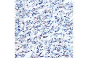 Immunohistochemistry of paraffin-embedded human liver cancer using OPTN Rabbit pAb (ABIN3015612, ABIN3015613, ABIN3015614 and ABIN6218972) at dilution of 1:100 (40x lens). (OPTN anticorps  (AA 1-577))