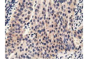 Immunohistochemical staining of paraffin-embedded Carcinoma of Human bladder tissue using anti-PRKD2 mouse monoclonal antibody. (PKD2 anticorps)