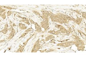 Immunohistochemical analysis of paraffin-embedded Human Breast cancer section using Pink1  8417b. (CDK5 anticorps)