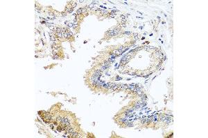 Immunohistochemistry of paraffin-embedded human prostate using MCCC2 antibody at dilution of 1:100 (x40 lens). (MCCC2 anticorps)
