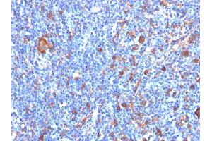 Formalin-fixed, paraffin-embedded human Hodgkin's Lymphoma stained with Fascin-1 Mouse Monoclonal Antibody (FSCN1/417)