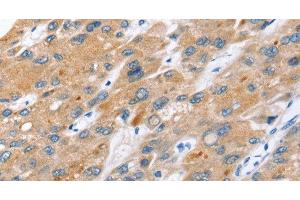 Immunohistochemistry of paraffin-embedded Human liver cancer tissue using ERVW-1 Polyclonal Antibody at dilution 1:45 (ERVW-1 anticorps)