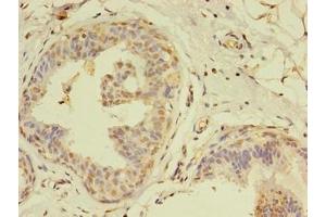 Immunohistochemistry of paraffin-embedded human breast cancer using ABIN7159241 at dilution of 1:100 (MLANA anticorps  (AA 1-118))