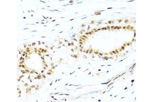 Immunohistochemistry of paraffin-embedded Human breast cancer using XRCC4 Polyclonal Antibody at dilution of 1:100 (40x lens). (XRCC4 anticorps)