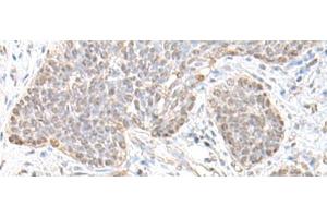 Immunohistochemistry of paraffin-embedded Human esophagus cancer tissue using TCF25 Polyclonal Antibody at dilution of 1:35(x200) (TCF25 anticorps)