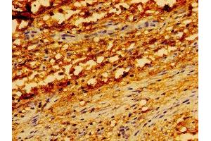 Immunohistochemistry of paraffin-embedded human melanoma using ABIN7173904 at dilution of 1: 100 (TRADD anticorps  (AA 1-312))