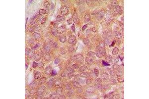 Immunohistochemical analysis of SEN54 staining in human breast cancer formalin fixed paraffin embedded tissue section. (TSEN54 anticorps)
