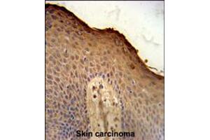 ISM1 Antibody immunohistochemistry analysis in formalin fixed and paraffin embedded human skin carcinoma followed by peroxidase conjugation of the secondary antibody and DAB staining. (ISM1 anticorps  (C-Term))