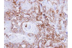 IHC-P Image Immunohistochemical analysis of paraffin-embedded CA922 xenograft, using EGFR, antibody at 1:500 dilution.